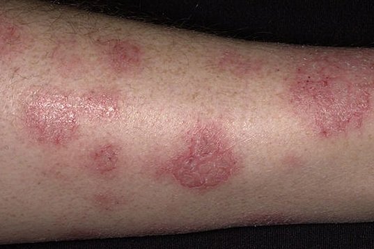 Brown Patchy Skin On Lower Legs