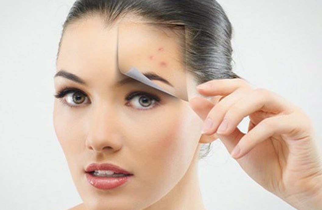 how-to-get-rid-of-blind-pimples