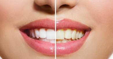Teeth whitening Tips