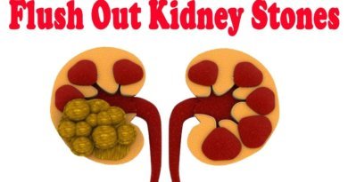 What are Kidney Stones
