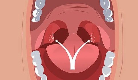 How-to-Get-Rid-of-Tonsil-Stones-Remove-Tonsil-Stones